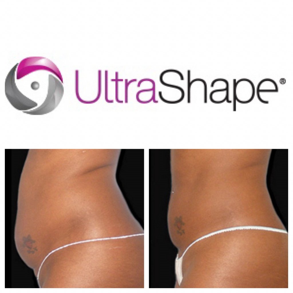 before and after photo for ultrashape procedure stomach