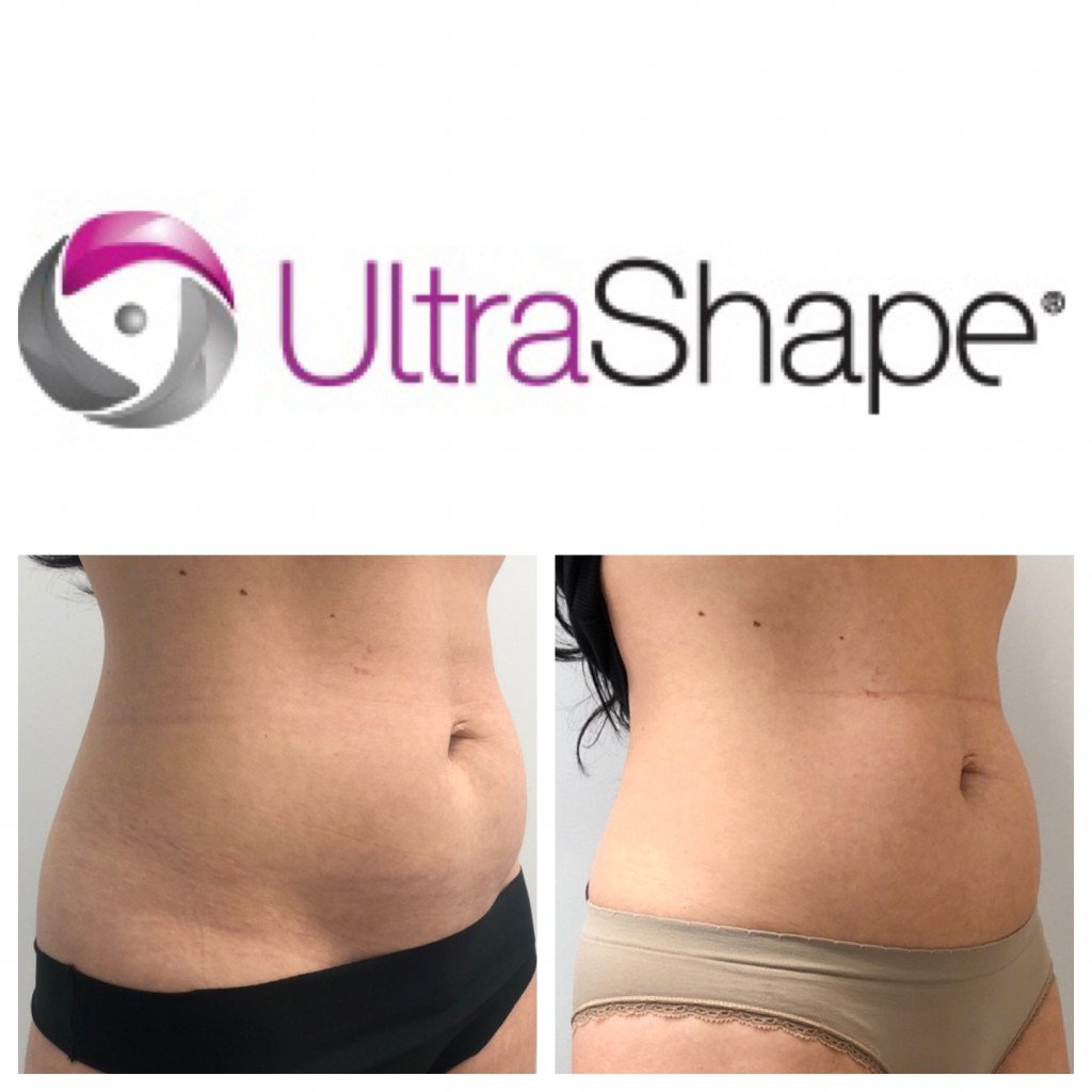 before and after photo for ultrashape procedure stomach
