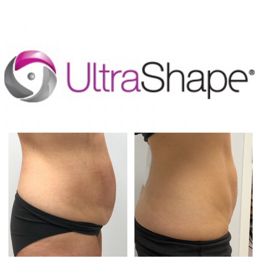 before and after photo ultrashape stomach