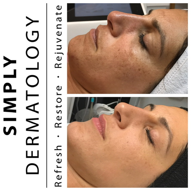 Facials More Dr Papantoniou Cosmetic Dermatologist In Long Island