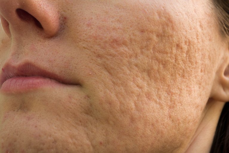 pictuer of acne damage to side of face