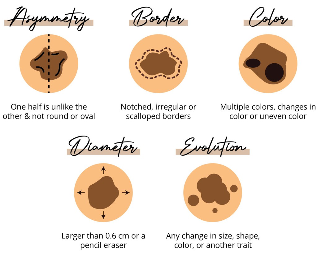mole vs melanoma skin check chart