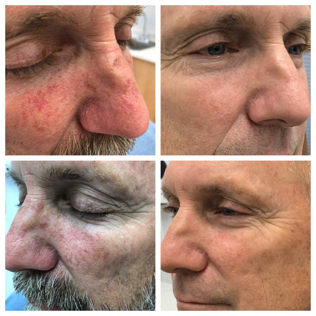 IPL Treatment Man Face Before and After
