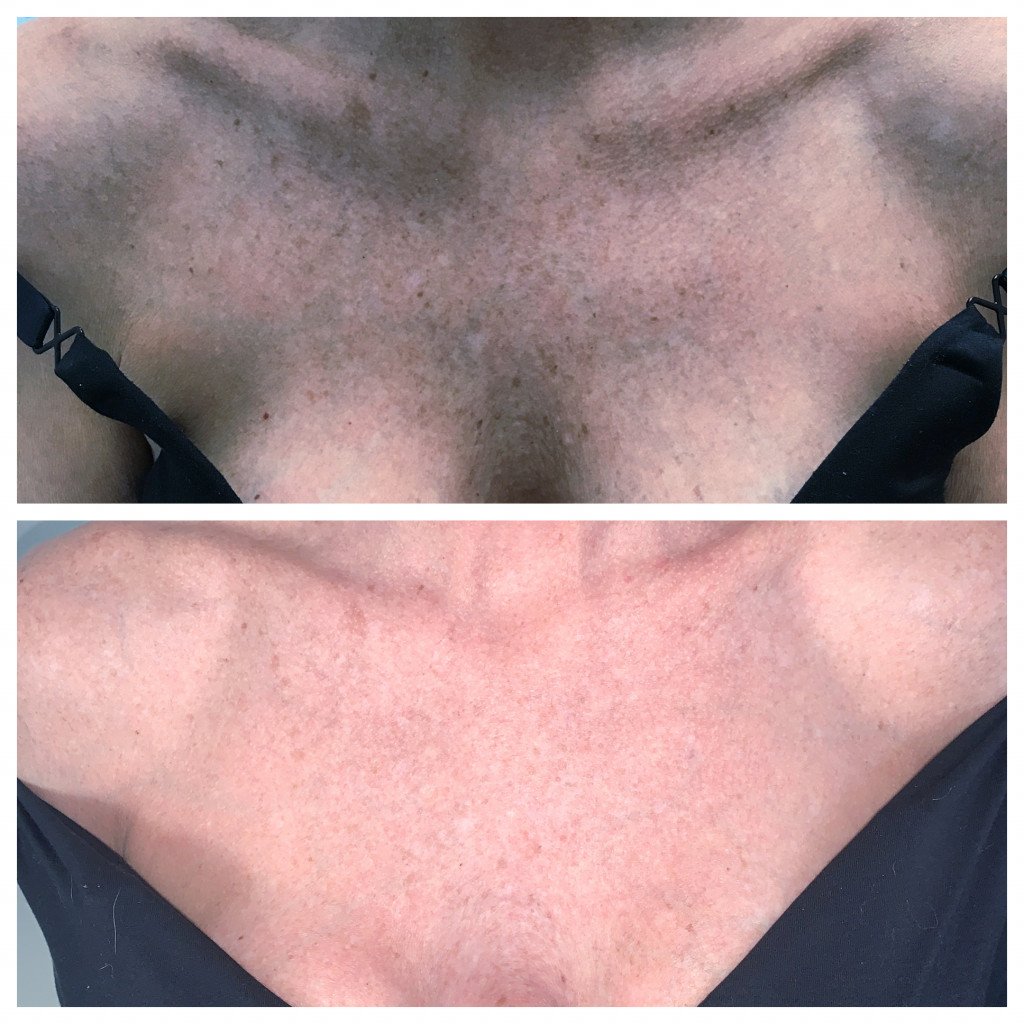 IPL Treatment Neck Region Before and After