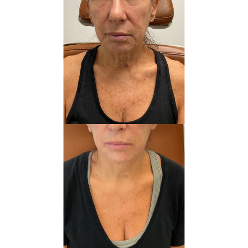 Frontal view of a woman in her 50s before and after Ultherapy treatment to tighten and lift the lower face and décolletage at Simply Dermatology in Long Island.