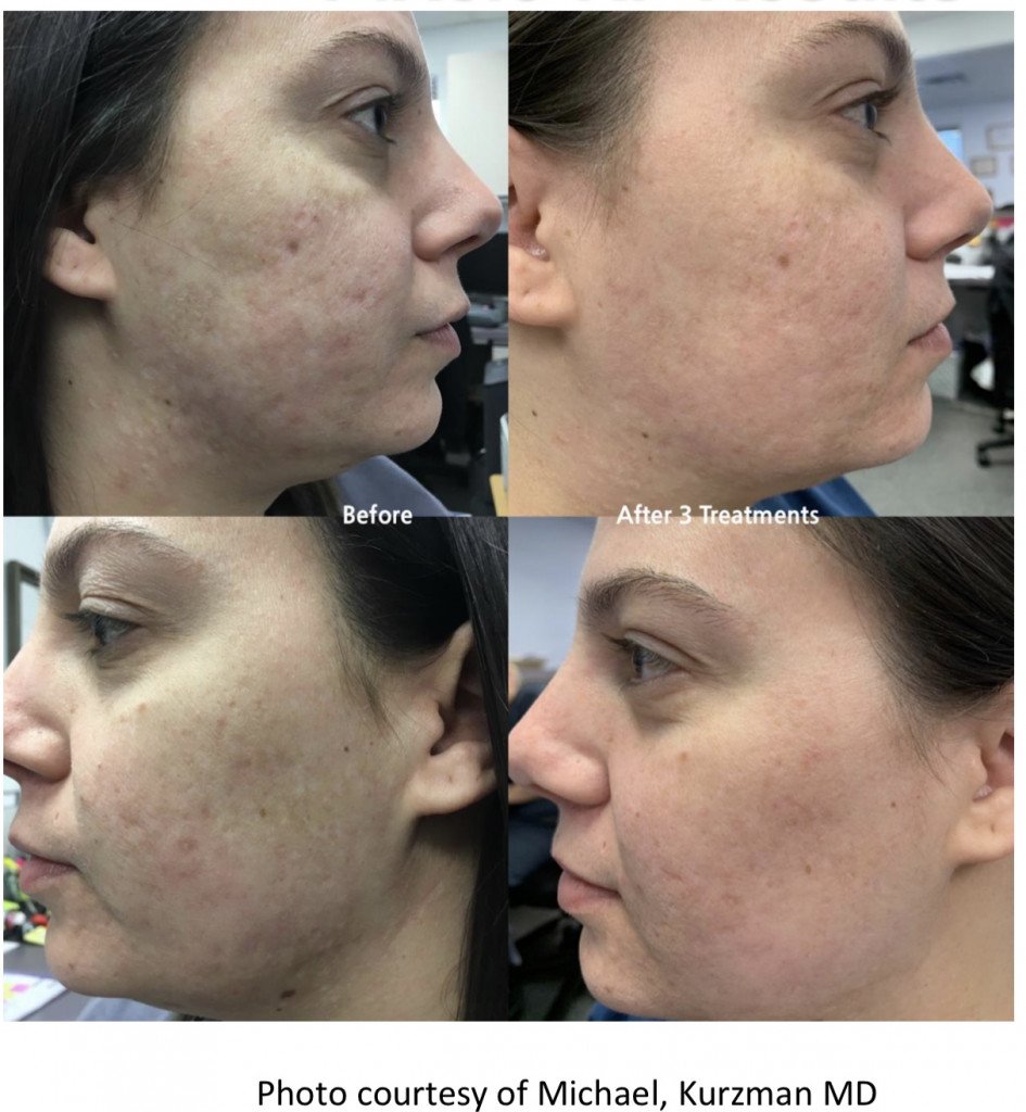Before and After photo of woman side profile neck and face resurfacing