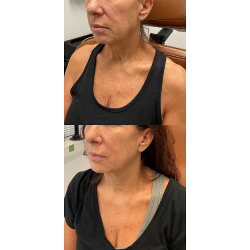 Before and after Ultherapy results on the lower face and décolletage of a woman in her 50s, treated at Simply Dermatology in Long Island.