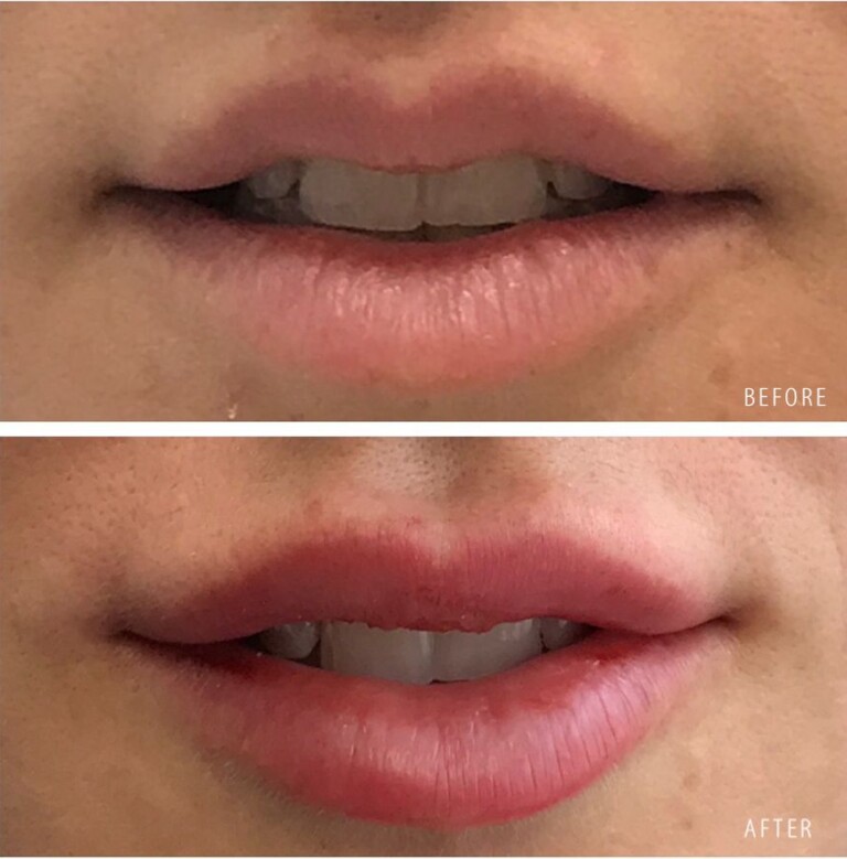 A before-and-after close-up of a woman’s lips showing a fuller, more defined appearance after lip filler treatment. The words before and after appear on the images.