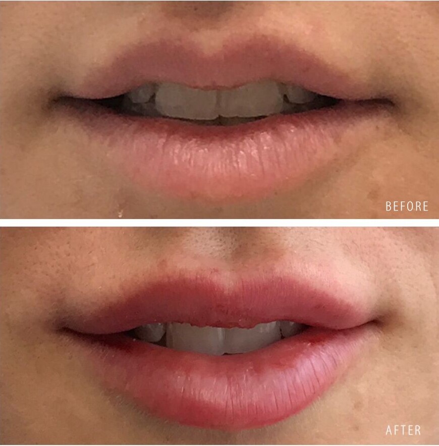 A before-and-after close-up of a woman’s lips showing a fuller, more defined appearance after lip filler treatment. The words before and after appear on the images.