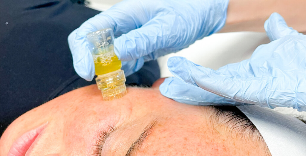 Woman Getting Aquagold applied to her Face