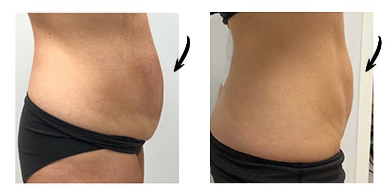 Before and After: Fat Reduction on stomach