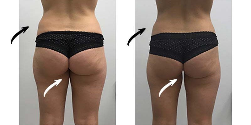 Before and After: Fat Reduction on flanks and thighs