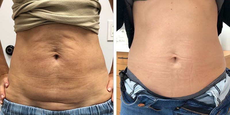 Before and After: Body Contouring - Skin Tightening
