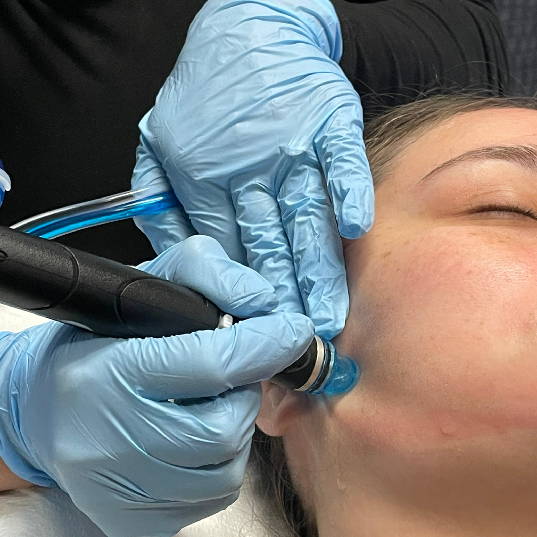 Close‑up of Sam performing a Platinum Hydrafacial on a patient’s cheek at Simply Dermatology, using a blue‑tipped wand.