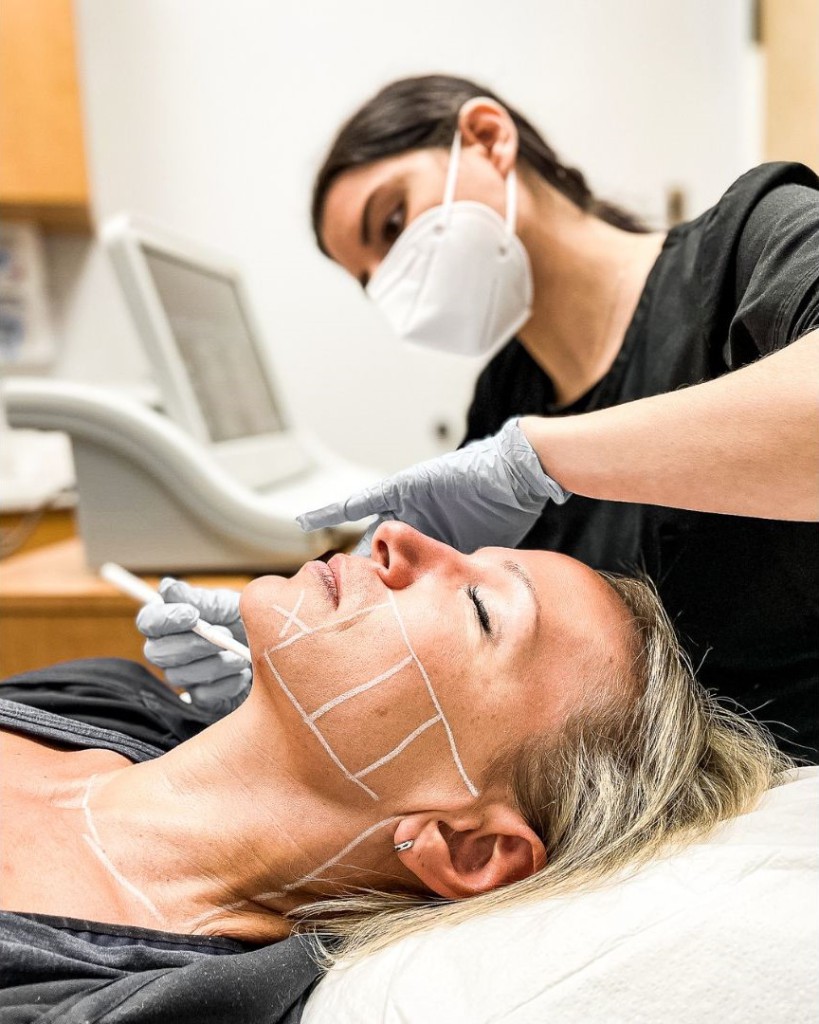 laser Specialist Sam Criscione ulthera on patient's face