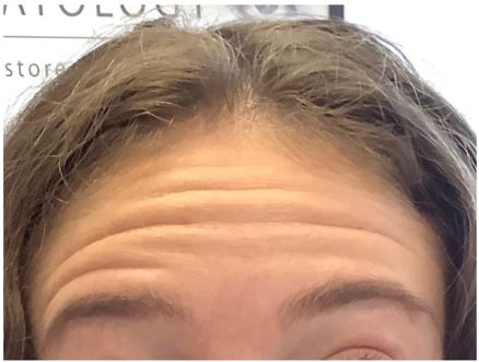 Close-up of the forehead before Botox, showing several horizontal expression lines as the eyebrows are raised.