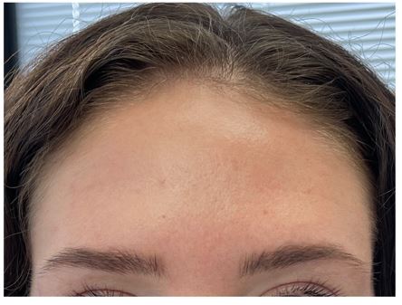 Close-up of the forehead after Botox, showing smoother skin with less visible horizontal forehead lines.