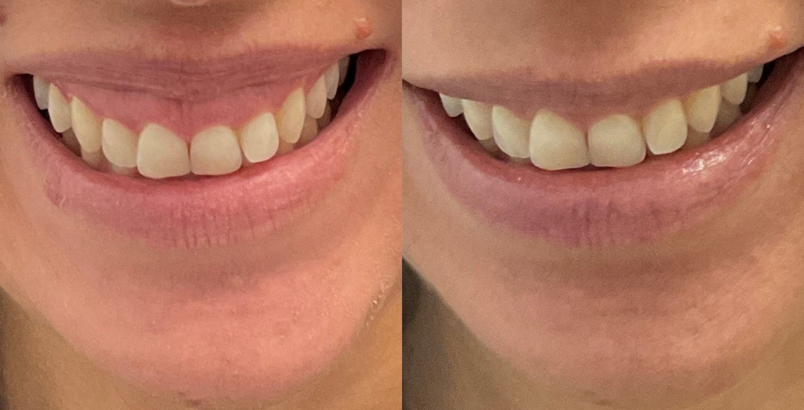 botox gummy smile before and after