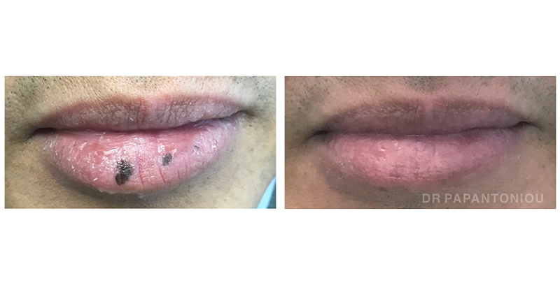 Q switch before and after on lips