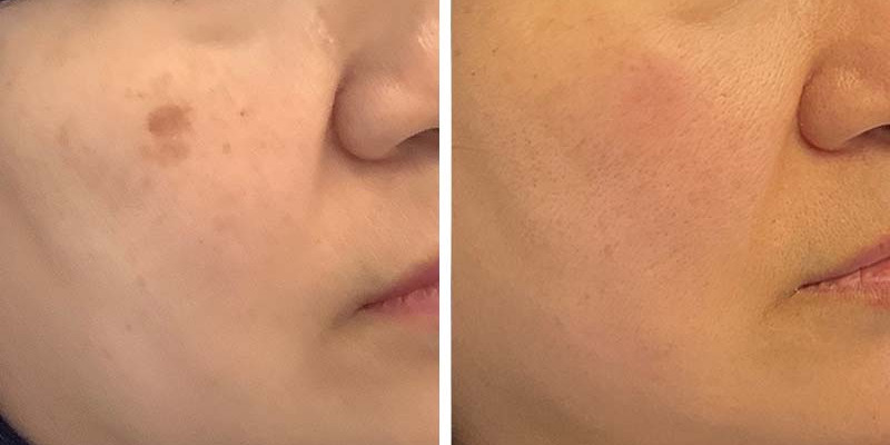 Before and After: Discoloration and Sun damage