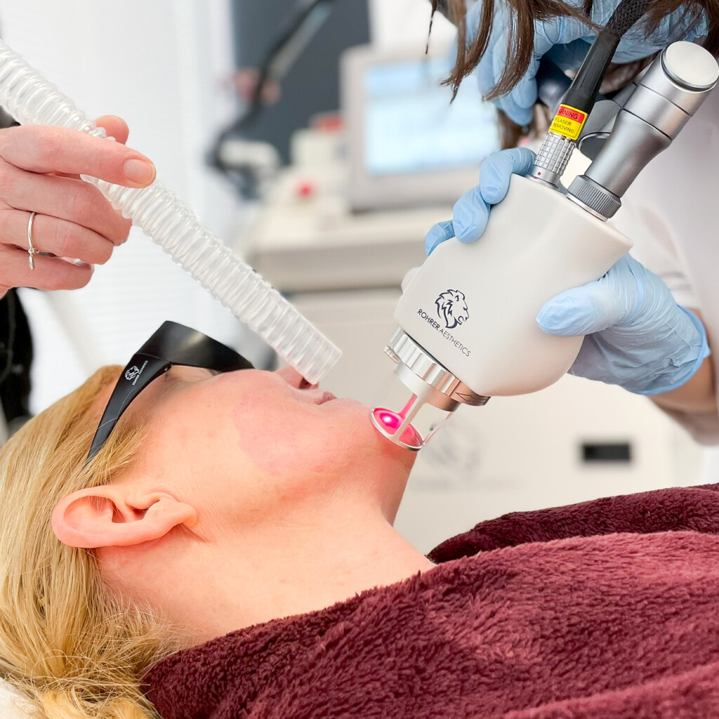 A provider performs fractional CO2 laser resurfacing on a patient’s cheek while an assistant holds a smoke evacuator nearby.