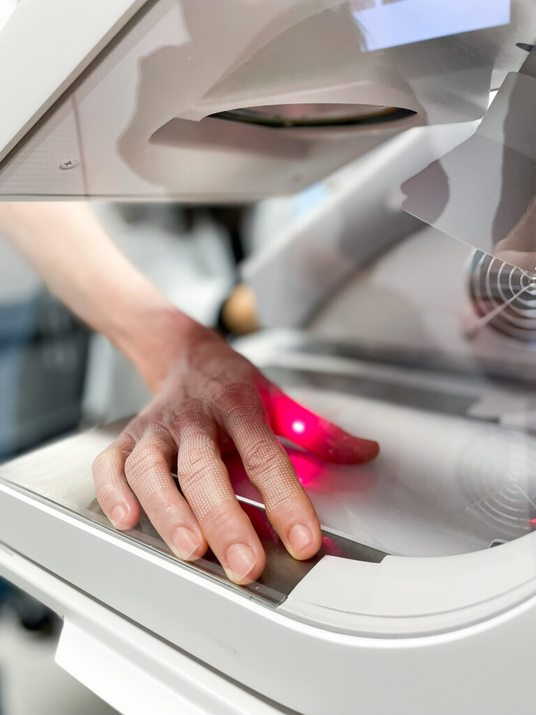 A patient’s hand positioned beneath a fractional CO2 laser as a red treatment light targets the skin.