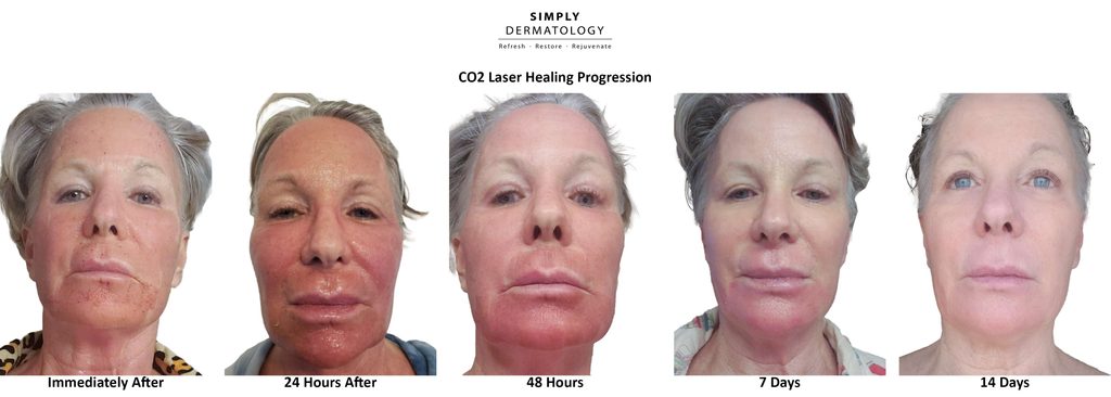 Patient’s CO2 laser healing progression immediately after treatment and at 24 hours, 48 hours, seven days, and 14 days.