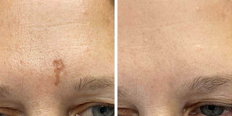 Before and After: Wrinkles, Scars, and Pores