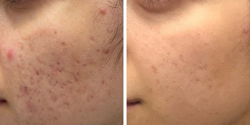 Before and After: Wrinkles, Scars, and Pores