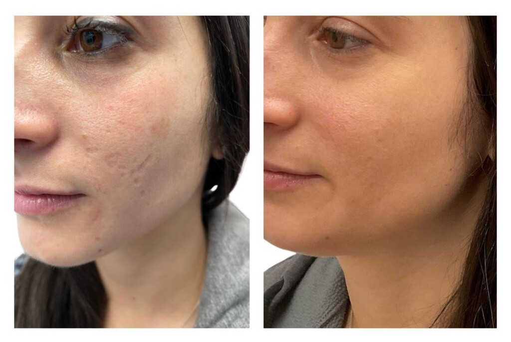 Acne Scarring Before and After done with Chemical Peels and Fraxel. Side by side of noticeable improvements in texture. 