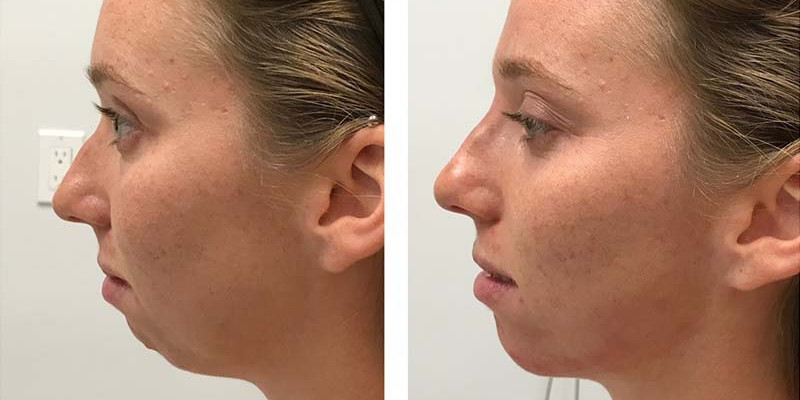 Before and After: Chin Filler