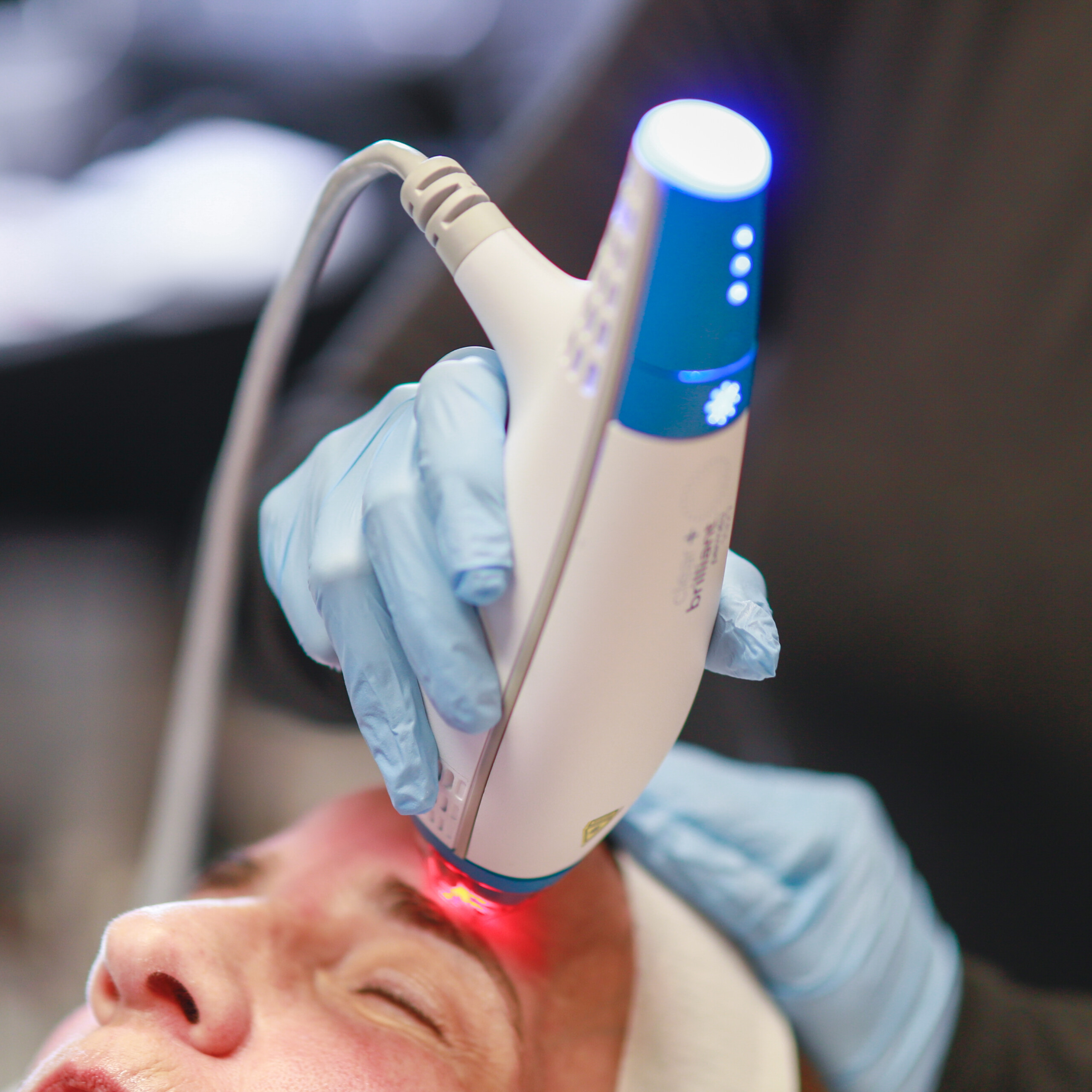 Clear + Brilliant fractional laser treatment being performed on a patient’s forehead at Simply Dermatology in Melville, Long Island.