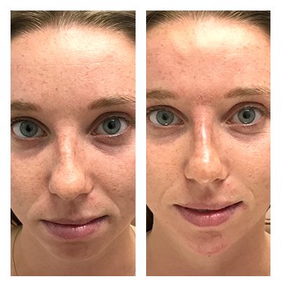 Expert Injectables Contour Results