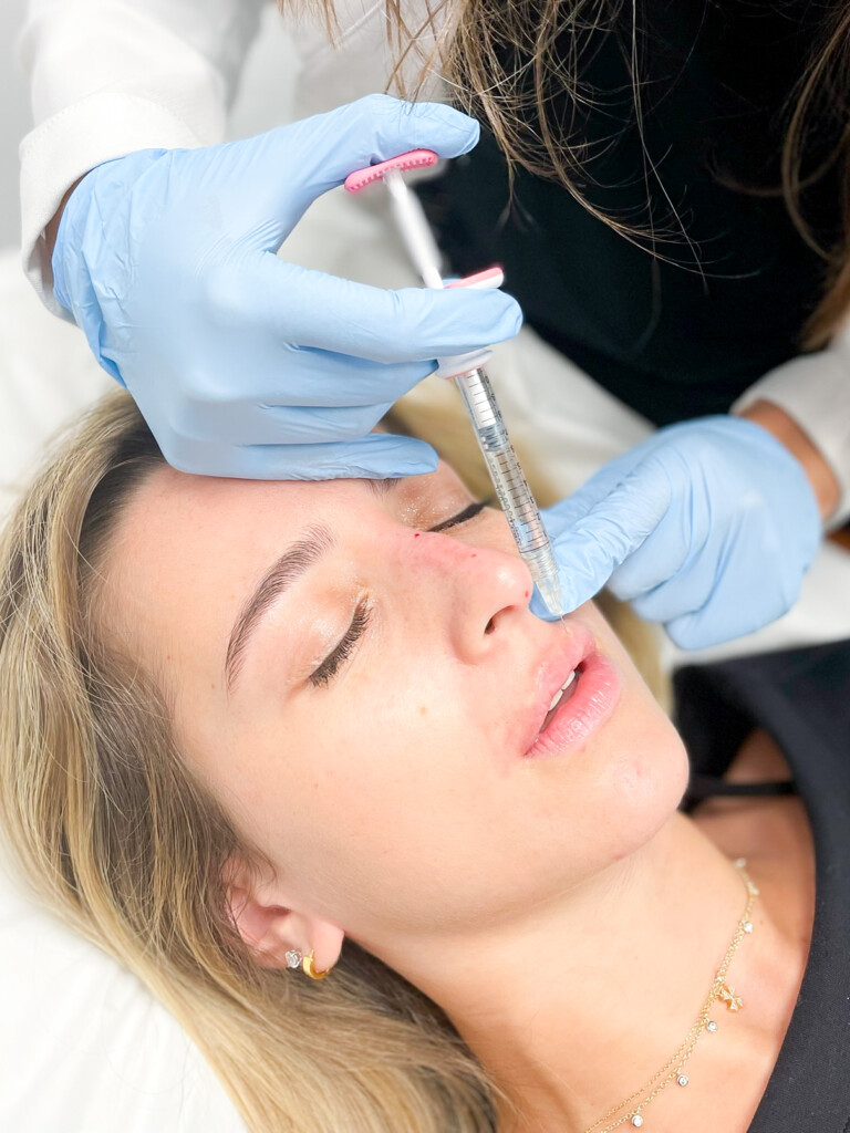 Close-up of a medical provider wearing blue gloves administering a precise filler injection near a patient’s nose and upper lip area.