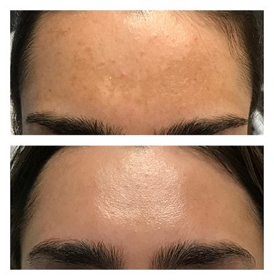 Complexion Discoloration and Sun Damage Treatment Results
