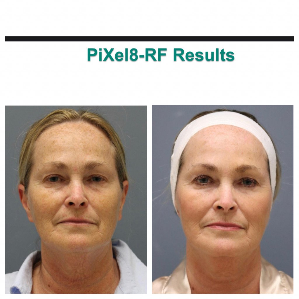 Before and After photo of woman face resurfacing