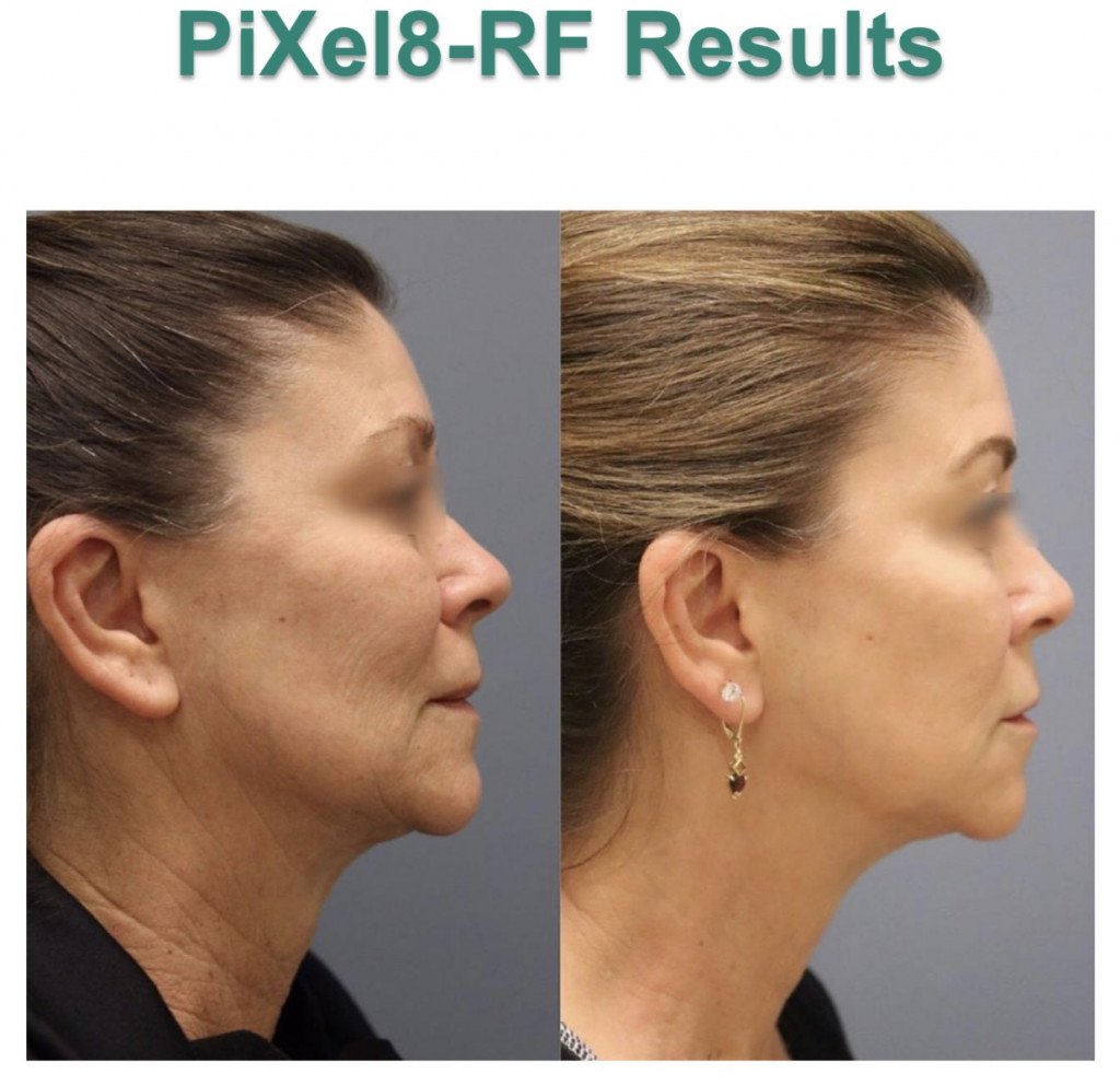 Before and After photo of woman side profile neck 