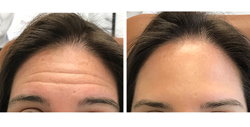 Before and After: Forehead Botox
