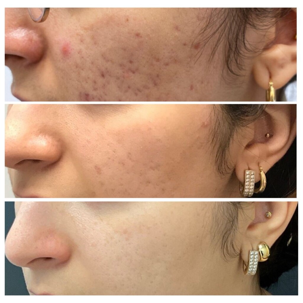 Before and after progression of acne treatments.