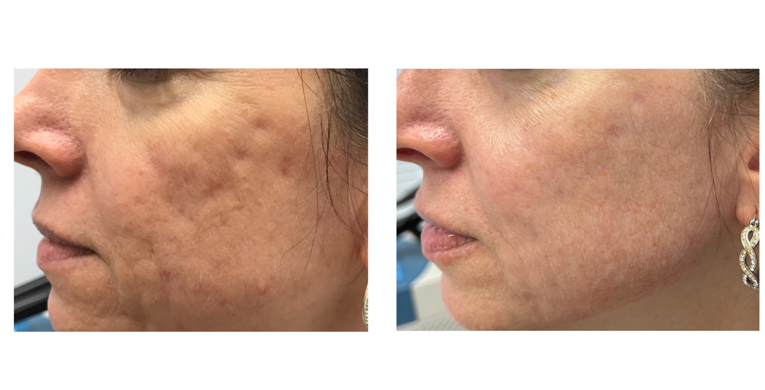 Before and After: Fraxel and Fillers for Acne Scarring