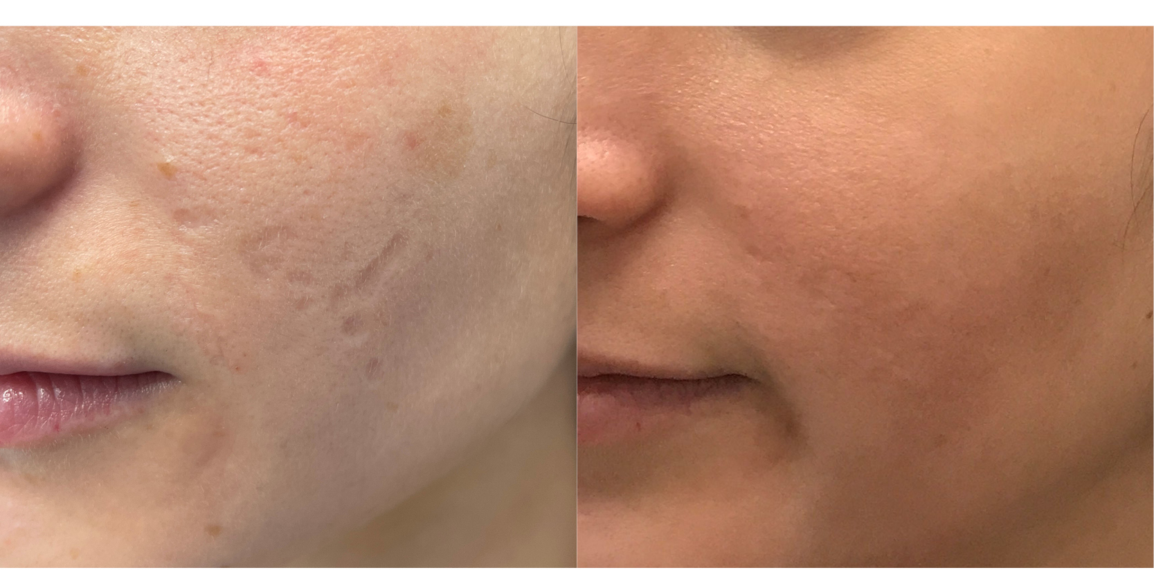 Before and After Fraxel and chem peels for acne scarring
