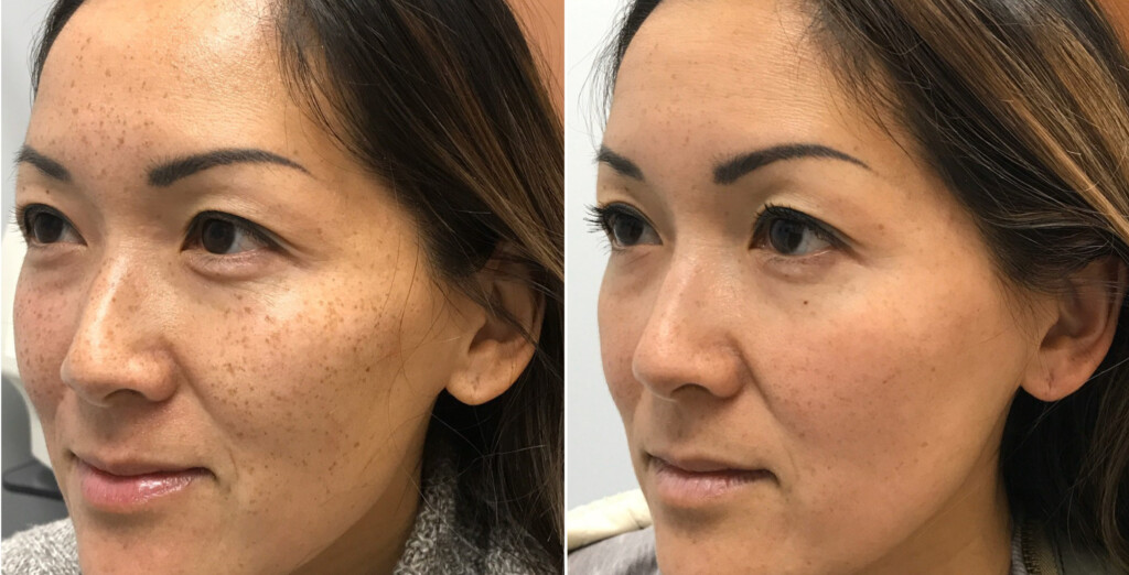 Fraxel for skin discoloration before and after