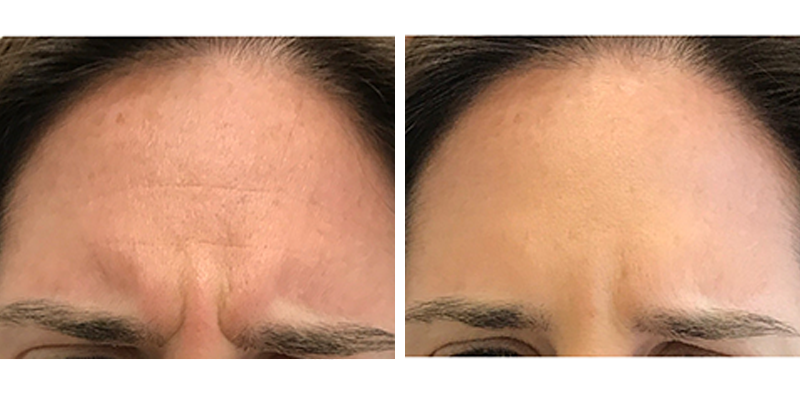 Before and After: Glabella Botox