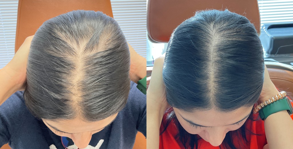 Hair Loss before and after