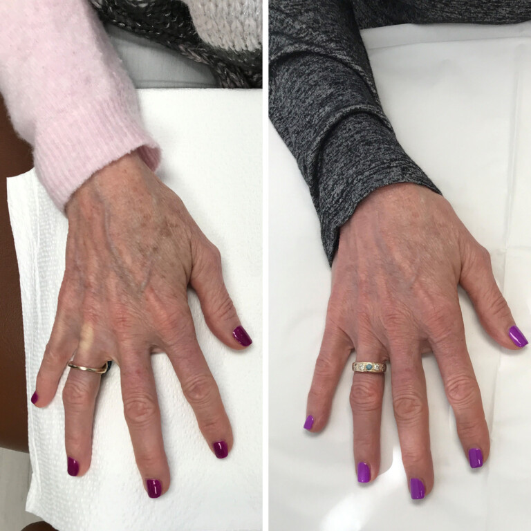 Before and after comparison of aging hands, showing improved skin texture and reduced prominence of spots from a Q Switch Treatment.
