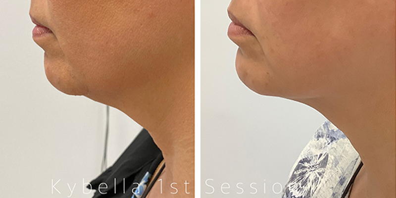 Before and After: Kybella for 