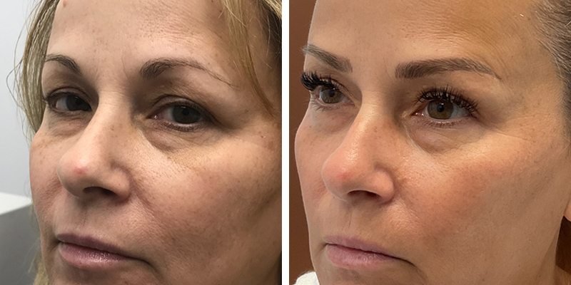 Before and After: Skin Tightening