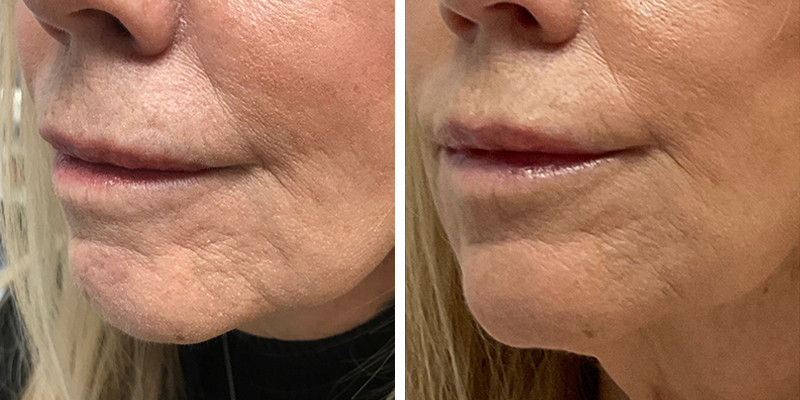 Before and After: Skin Tightening