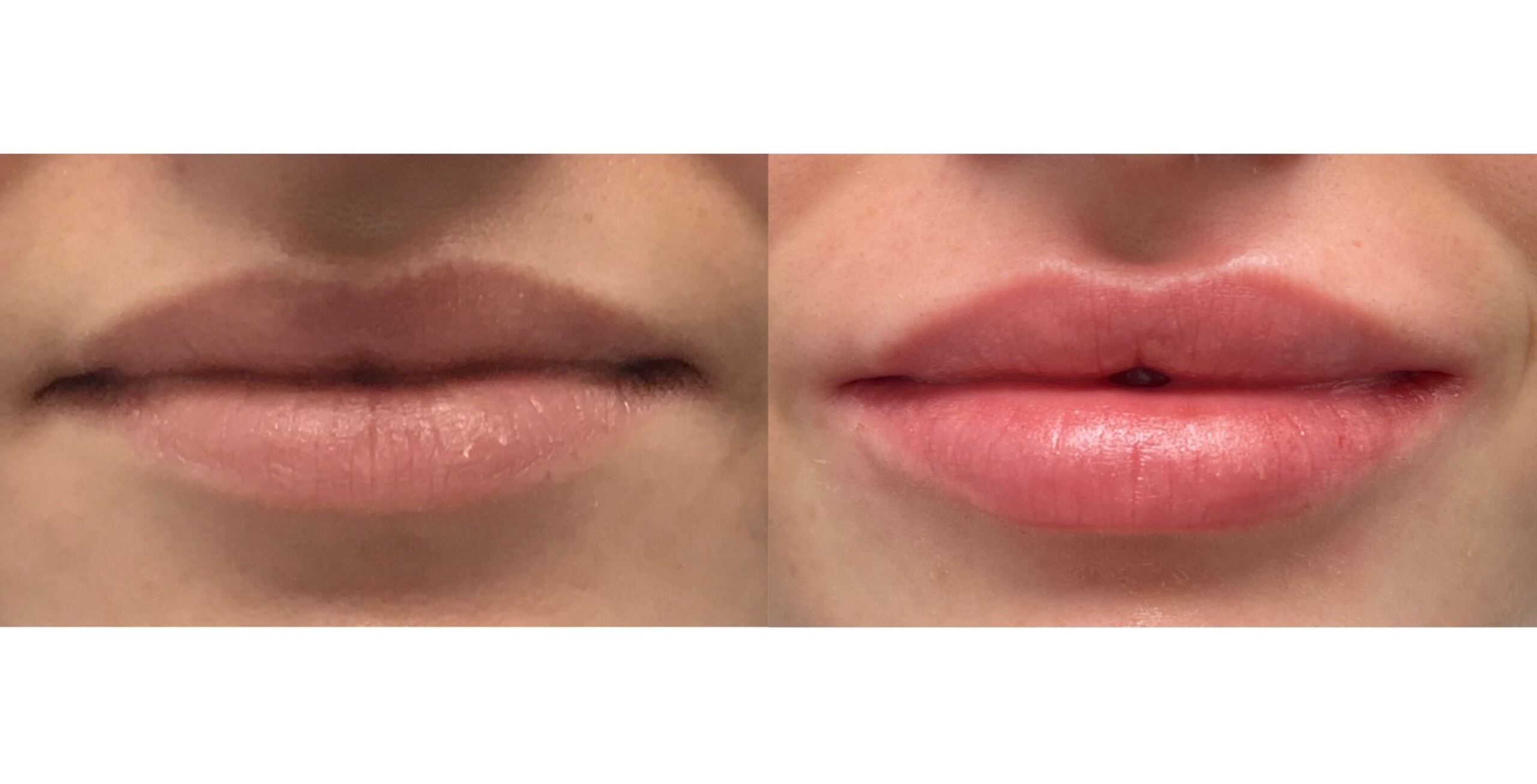 Before and after lip filler showing enhanced volume, improved symmetry, and natural-looking definition.
