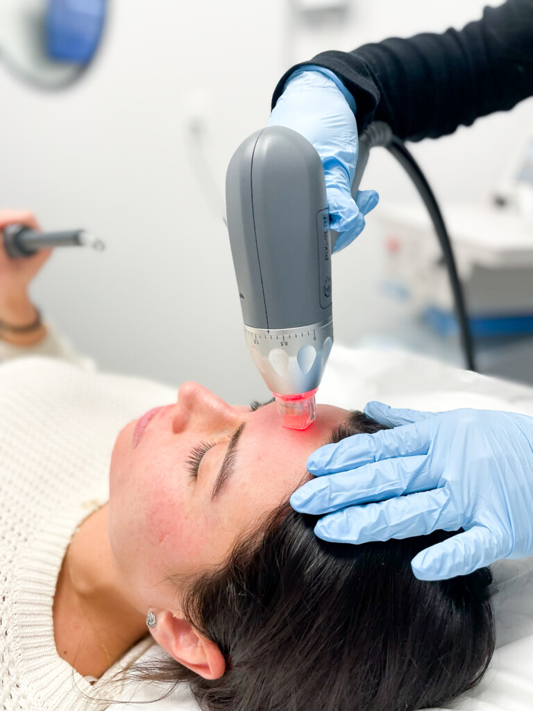 Micro RF treatment being performed on a patient’s forehead at Simply Dermatology in Melville, Long Island.